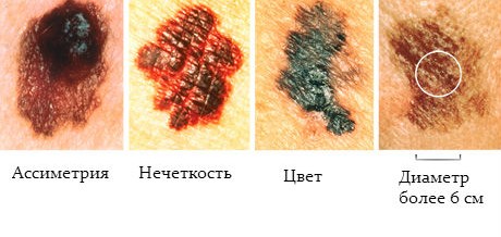 Симптомы меланомы кожи